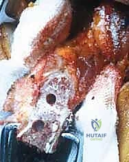 تآكل العظم الحقاني وفقدان الاستقرار