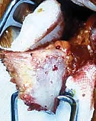 استعادة المدى الحركي الكامل للكتف