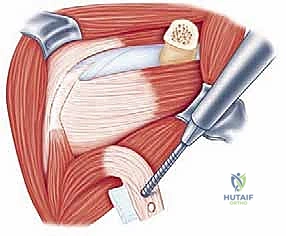 عملية لاتارجيه المتقدمة: حل شامل لعدم استقرار الكتف الأمامي وفقدان العظم الحقاني في صنعاء
