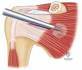 صورة توضيحية لـ عملية لاتارجيه المتقدمة: حل شامل لعدم استقرار الكتف الأمامي وفقدان العظم الحقاني في صنعاء