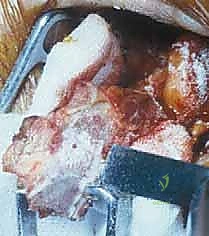 صورة توضيحية لـ عملية لاتارجيه المتقدمة: حل شامل لعدم استقرار الكتف الأمامي وفقدان العظم الحقاني في صنعاء