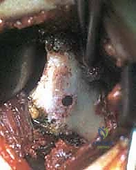 الأستاذ الدكتور محمد هطيف أثناء إجراء الجراحة