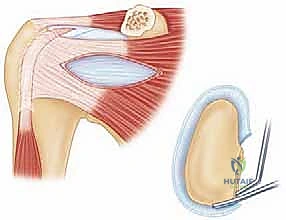 أسباب خلع الكتف الأمامي المتكرر