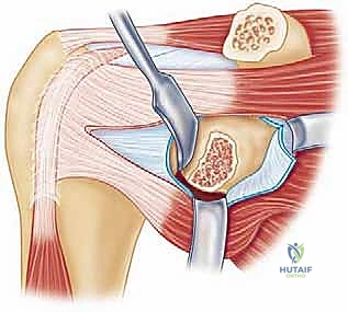 نقل الناتئ الغرابي لترميم التجويف الحقاني