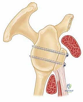 الأعراض السريرية لعدم استقرار الكتف