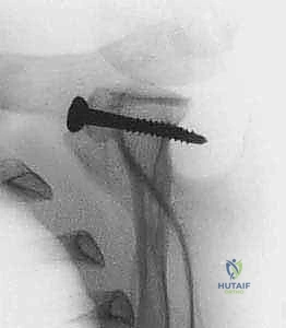 برنامج العلاج الطبيعي وتأهيل الكتف