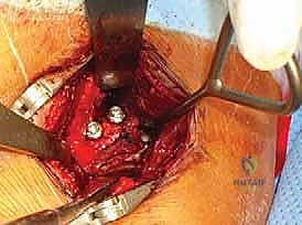 مبدأ الحجب الثلاثي في عملية لاتارجيه