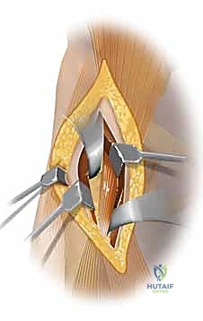 الأسباب الشائعة وآليات حدوث كسر رأس الفخذ