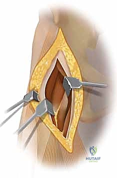 تشريح العضلات والأعصاب المحيطة بمفصل الورك