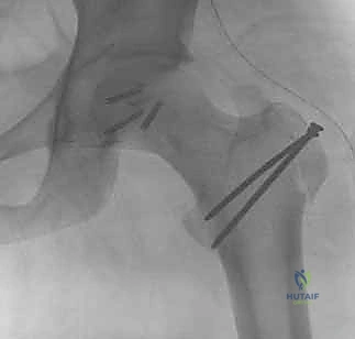 صورة توضيحية لـ كسر رأس الفخذ: دليلك الشامل للعلاج والتعافي مع الأستاذ الدكتور محمد هطيف في صنعاء