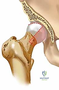الخلع الجراحي الآمن للورك بتقنية جانز