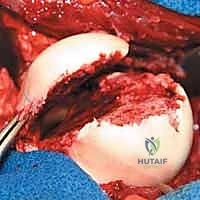 Femoral Head Fracture Fixation: An Intraoperative Masterclass
