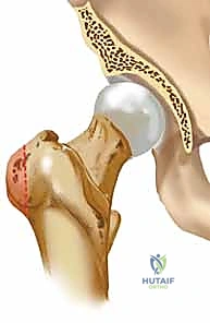 التخطيط الجراحي لكسور رأس الفخذ