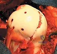 صورة توضيحية لـ كسر رأس الفخذ: دليلك الشامل للعلاج والتعافي مع الأستاذ الدكتور محمد هطيف في صنعاء