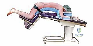 التخطيط الجراحي لاستئصال الصفيحة الفقرية