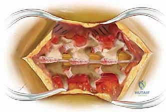 تقنيات التثبيت والدمج الفقري بالمسامير