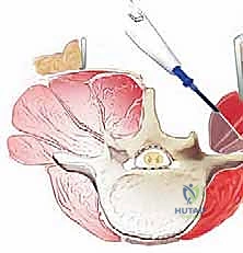 الخطوات الدقيقة لاستئصال الغضروف وتحرير العصب