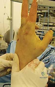 فحص استقرار مفصل DRUJ بعد تثبيت الكعبرة