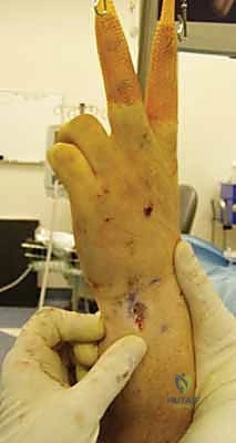 تقييم حالة مفصل الكعبرة الزندي البعيد أثناء الجراحة