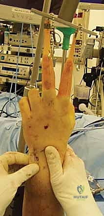 Reduction and Stabilization of the Distal Radioulnar Joint Following Galeazzi Fractures