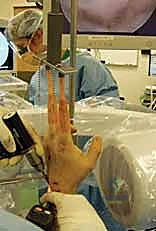 صورة شعاعية تظهر الشريحة والمسامير في مكانها المثالي