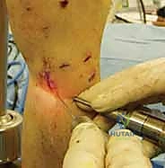 تثبيت الشريحة المعدنية على عظم الكعبرة