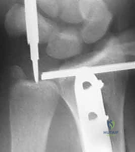 متابعة المدى الحركي للمريض في العيادة الخارجية