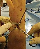 صورة توضح استعادة المريض لقدرته على تدوير الساعد