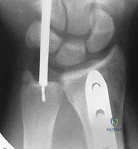 فحص قوة قبضة اليد بعد اكتمال العلاج الطبيعي