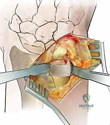 استخدام الجبائر الداعمة خلال فترة التأهيل فقط