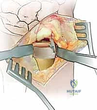 تثبيت مفصل DRUJ باستخدام أسلاك كيرشنر (K-wires) عند الحاجة