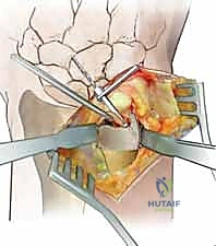 كسر غالييزي: دليل شامل لتقليل وتثبيت مفصل الكعبرة الزندي البعيد