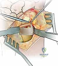 الأدوات الجراحية الدقيقة المستخدمة في تثبيت العظام