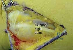 تجهيز الشريحة المعدنية لتثبيت الكسر