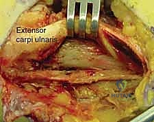 صورة شعاعية نهائية تظهر الالتئام التام للعظم