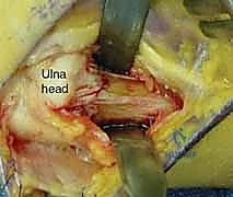 إغلاق الجرح الجراحي بطرق تجميلية دقيقة