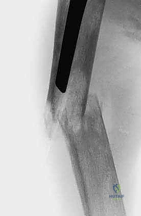 تأثير الأورام على الهيكل العظمي