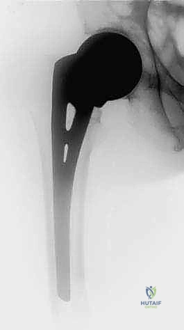 العلاج التحفظي مقابل الجراحي