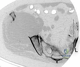 جراحات العمود الفقري المتقدمة