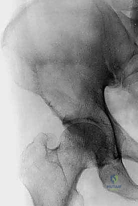 التثبيت الداخلي للعظام