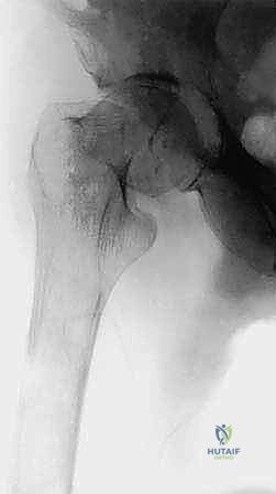 صورة توضيحية لـ جراحة نقائل العظام الثانوية المتقدمة في اليمن