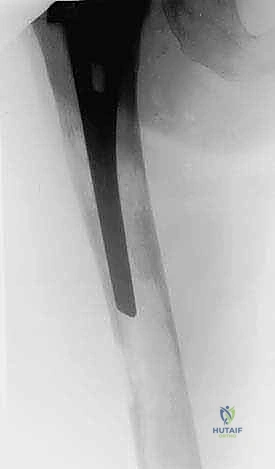 تقييم مخاطر الكسور المرضية