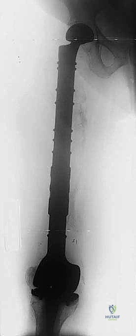 الكسور المرضية في عظم الفخذ