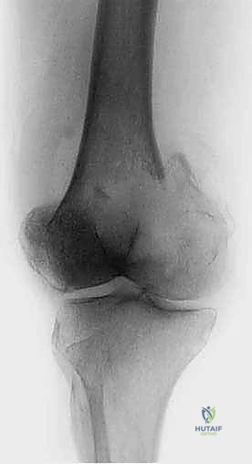 صورة توضيحية لـ جراحة نقائل العظام الثانوية المتقدمة في اليمن: دليل شامل للمرضى