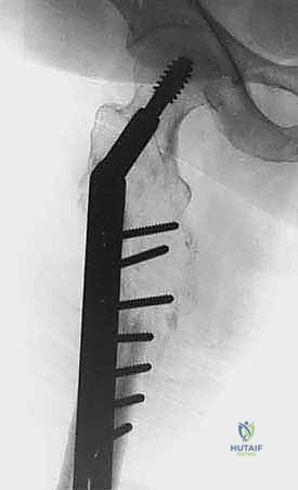 صورة توضيحية لـ جراحة نقائل العظام الثانوية المتقدمة في اليمن: دليل شامل للمرضى