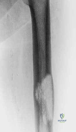 أثناء الإجراء الجراحي