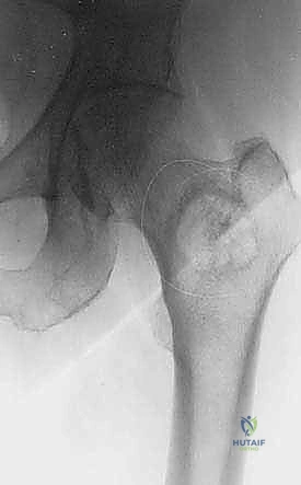 الدكتور محمد هطيف أثناء الجراحة