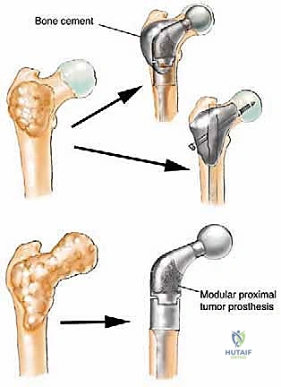 صورة توضيحية لـ جراحة نقائل العظام الثانوية المتقدمة في اليمن: دليل شامل للمرضى