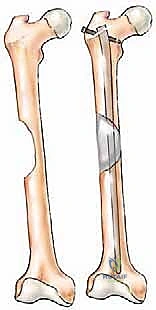 صورة توضيحية لـ جراحة نقائل العظام الثانوية المتقدمة في اليمن: دليل شامل للمرضى