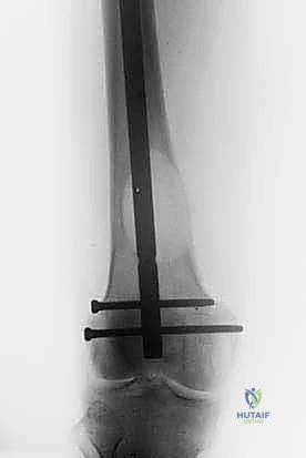 الأعراض العصبية لانضغاط الحبل الشوكي